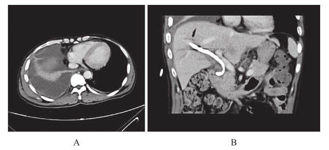 图5 腹部CT：胆管外引流管在位；胸部CT：右侧大量胸腔积液伴右肺不张.jpg